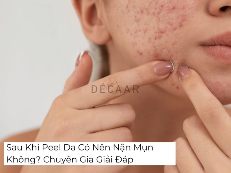 sau khi peel da có nên nặn mụn